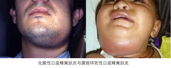 一颗智齿要了命,一颗智齿发炎