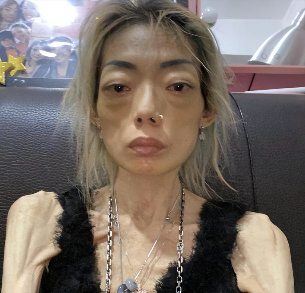 “最惨阔太”伍智恒：嫁豪门8年，换来牙齿全脱，体重仅剩44斤