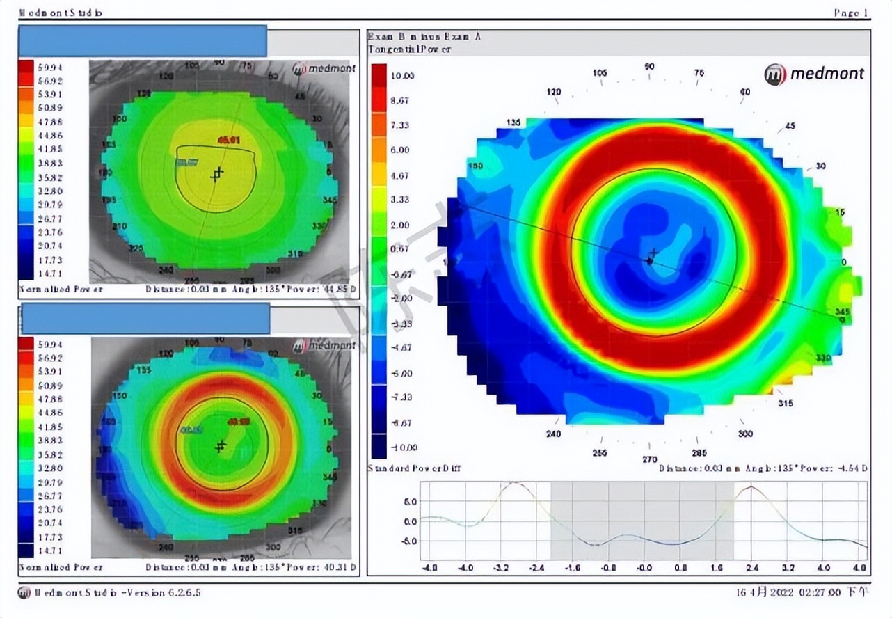 角膜接触镜验配案例图解,戴角膜塑形镜反复出现点染的原因