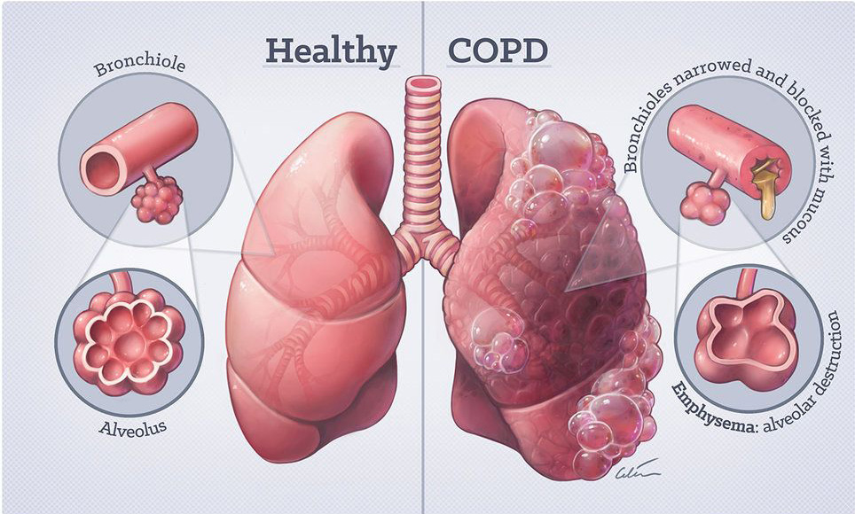 慢阻肺制氧机推荐,慢阻肺病人用什么品牌制氧机好