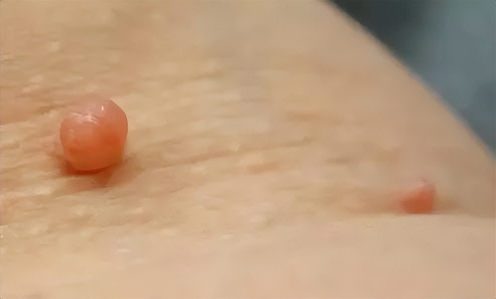 脖子上长了小肉粒可以揪掉吗,脖子上长的小肉粒自己揪掉可以吗