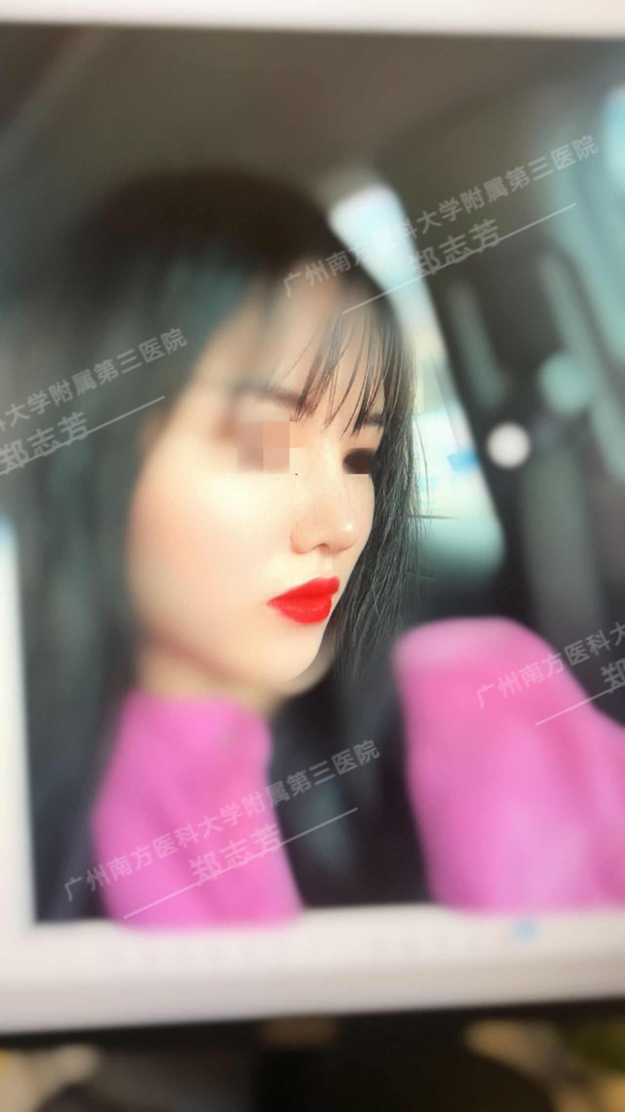 隆鼻后的注意事项和禁忌,隆鼻后需要注意的事项有哪些