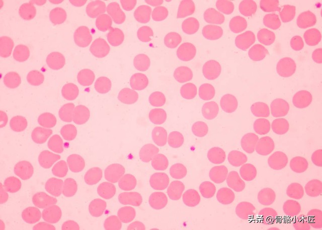 类风湿性关节炎二期表现,类风湿性关节炎二次复发好治吗