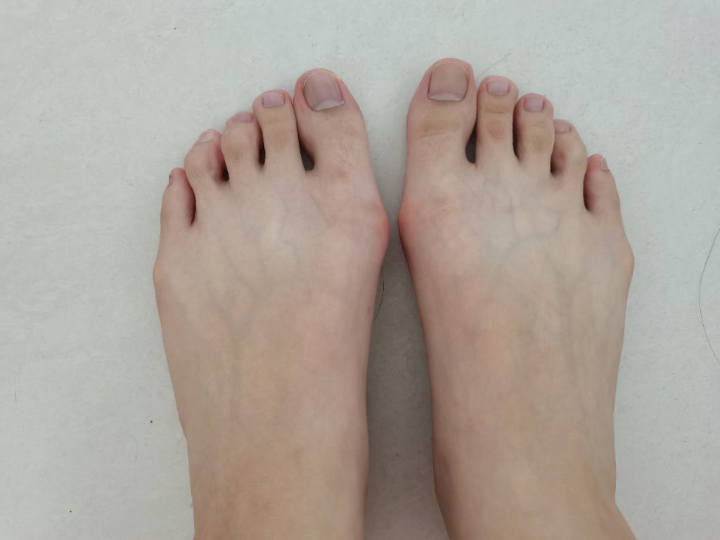 拇外翻怎么治疗呢,患了拇外翻怎么治疗比较好