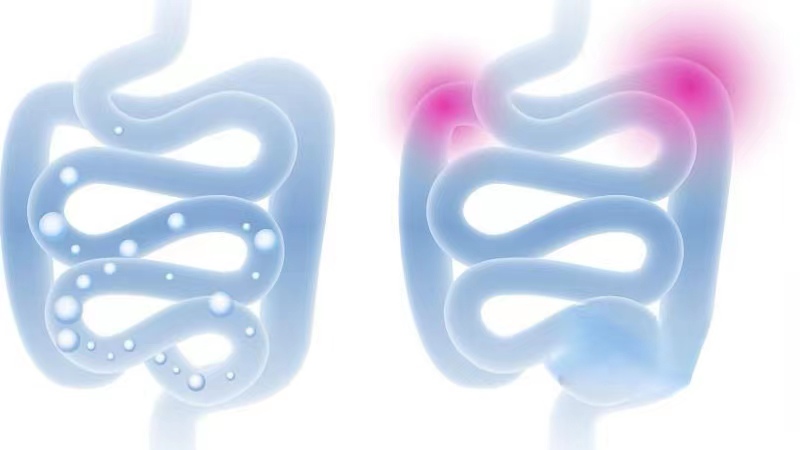 为什么会肠道长息肉,肠道容易长息肉是什么原因