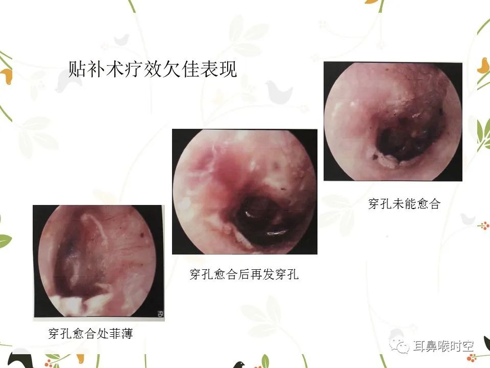 鼓膜可见穿孔,鼓膜穿孔听力下降能恢复吗