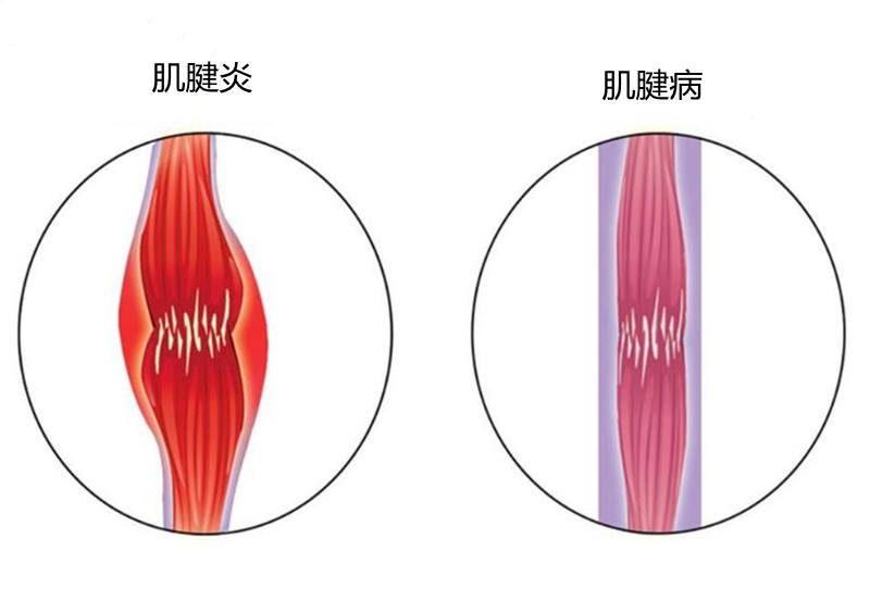 胳膊肘疼是颈椎引起的吗,胳膊疼是肌腱炎吗怎么治
