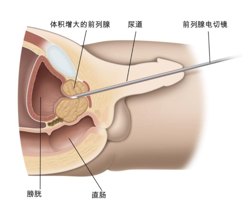 又又又尿裤子？男人逃不掉的疾病，女生勿进！