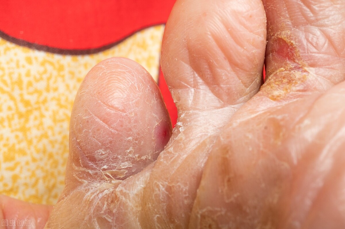 脚趾头脱皮水泡型足癣用什么药膏,足癣脚趾痒红肿怎么办