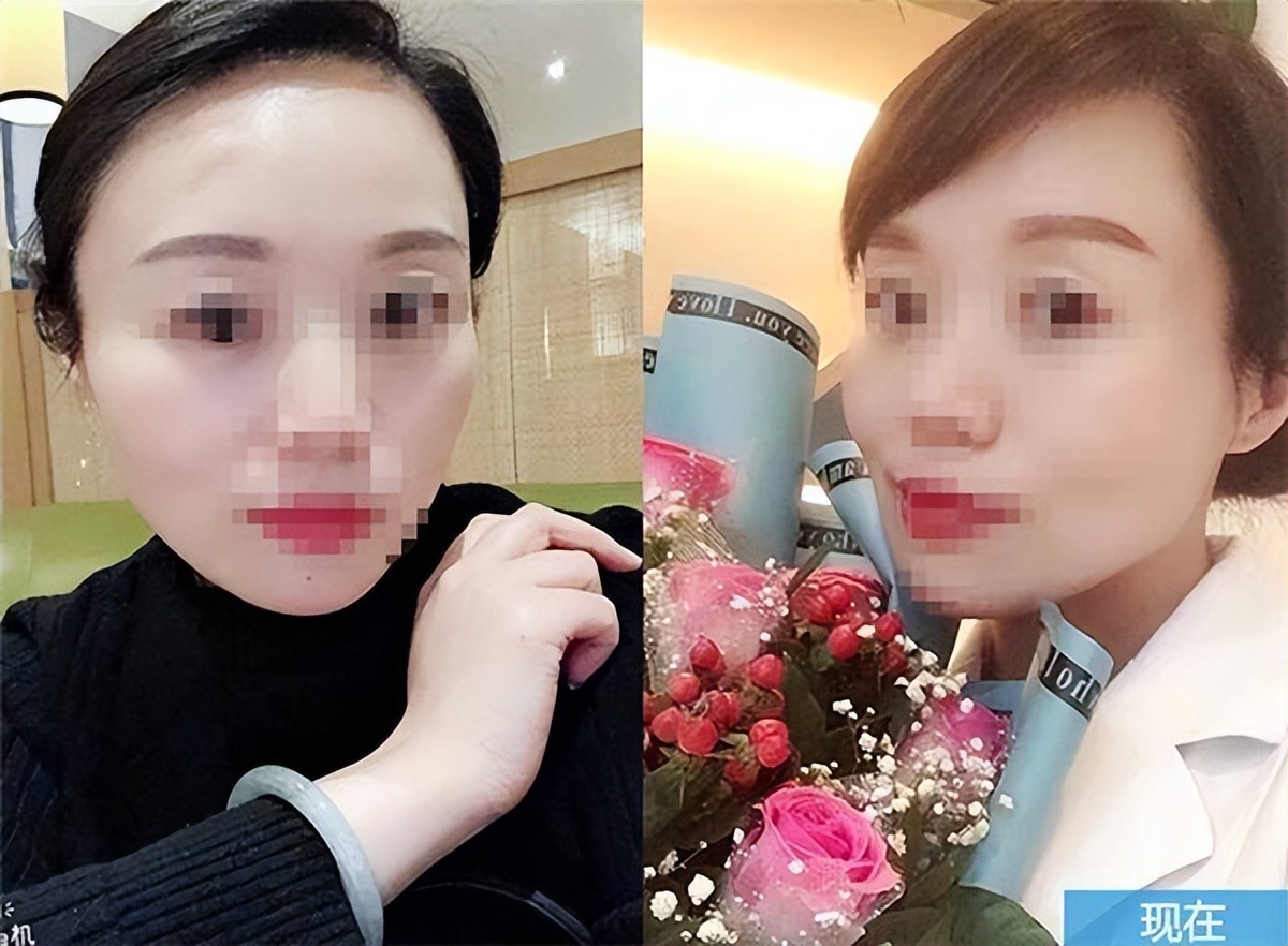 植发真的有用吗现在很多植发医院,效果最好的植发方法