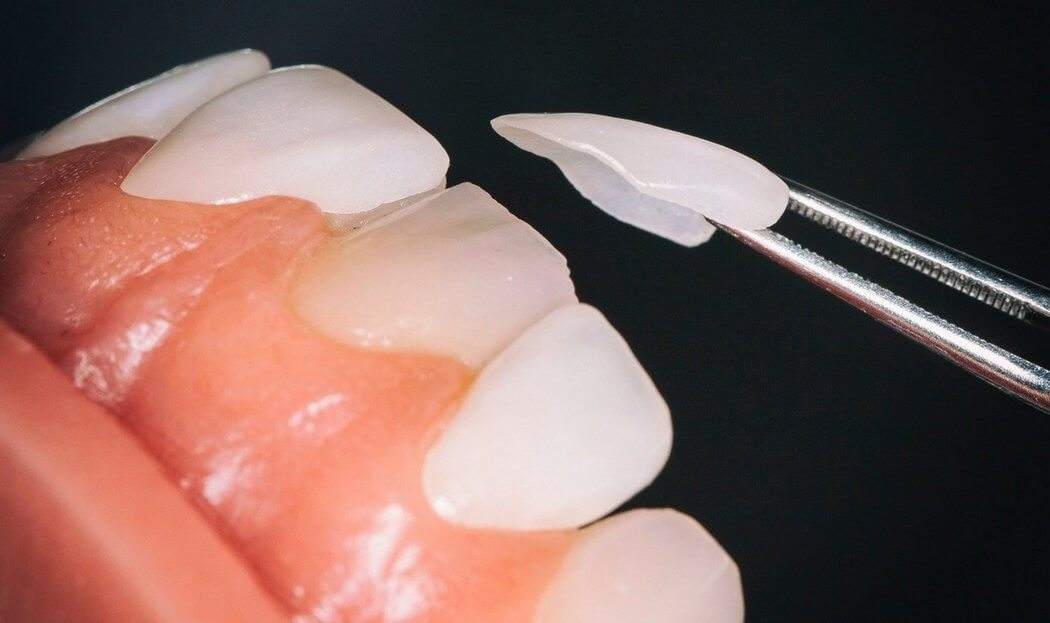 不用洗牙能把牙垢黄牙变白的方法,黑黄牙如何快速变白牙图片