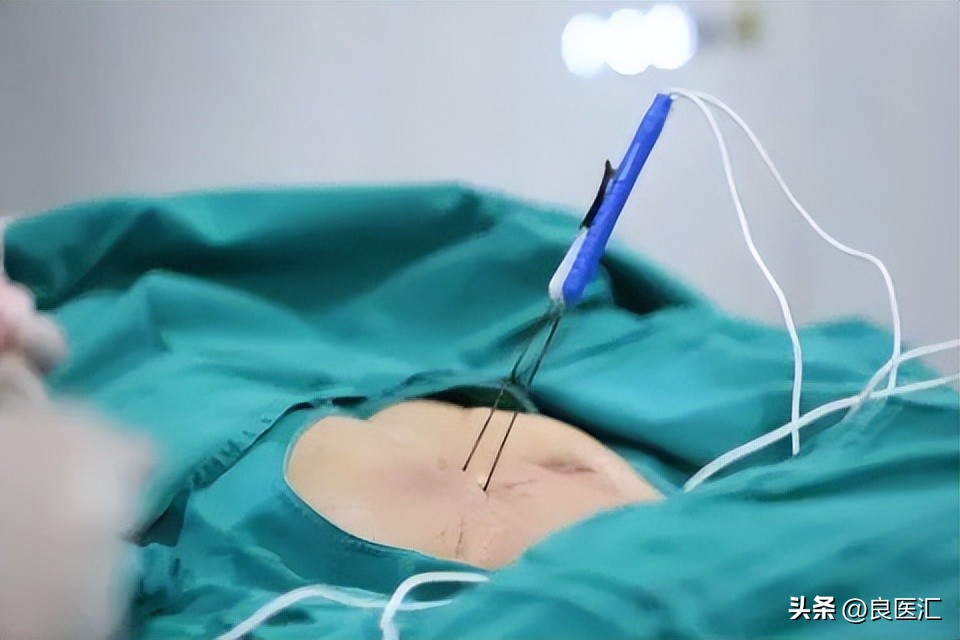 栓塞介入能消灭肿瘤吗,手术不用刀