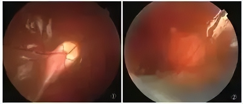 打篮球适合戴ok镜,戴半框眼镜能打篮球吗