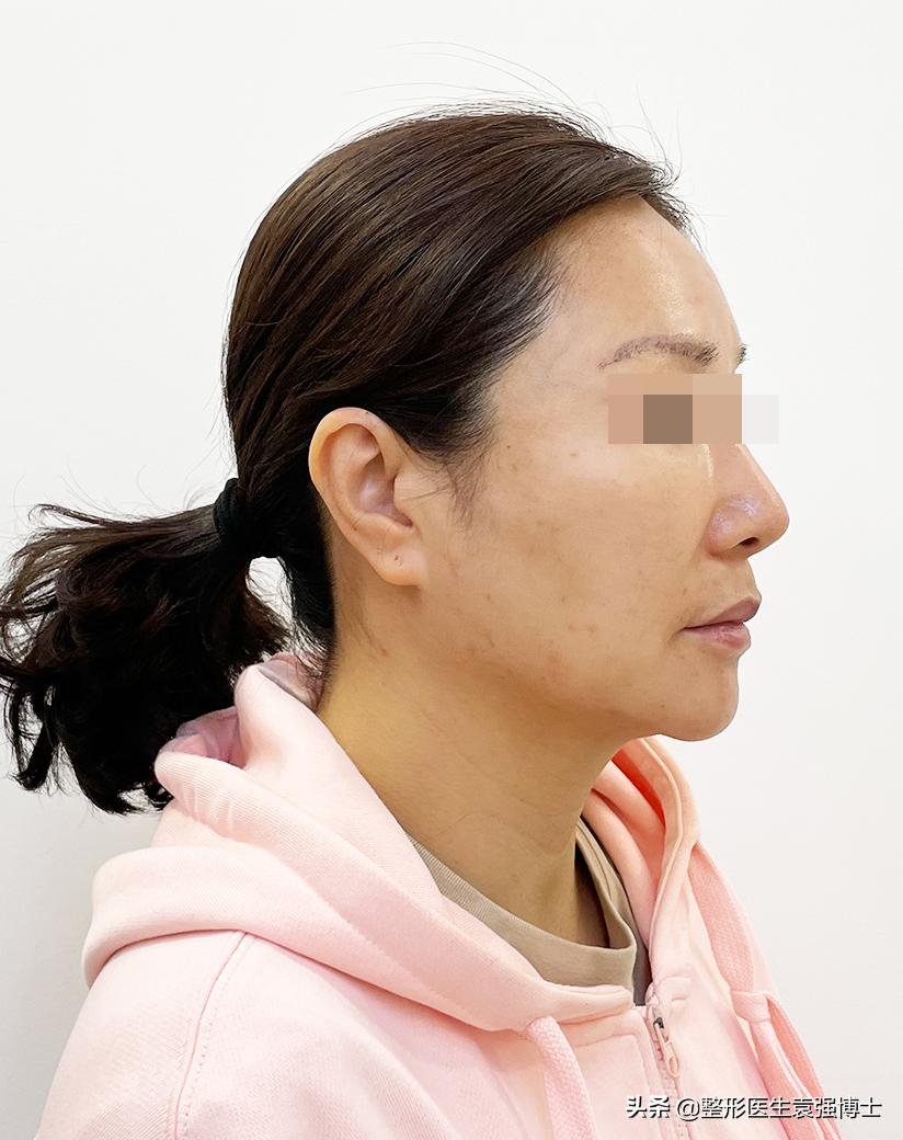 下颌缘拉皮提升前后对比图,小拉皮能改善下颌线吗