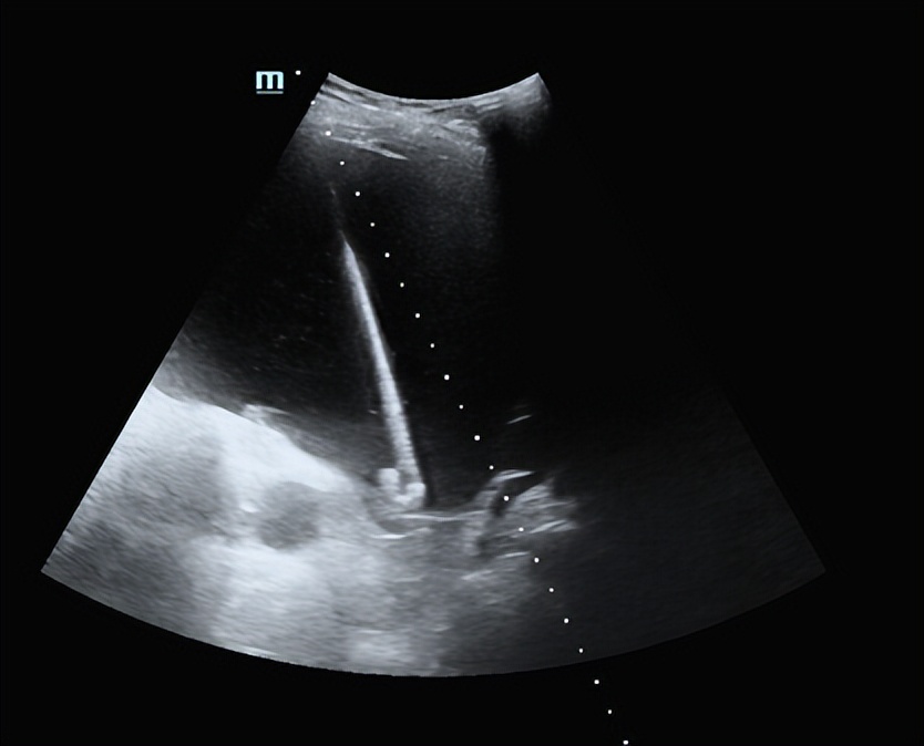 专家讲解多发肝囊肿治疗视频,多发性肝囊肿适合什么手术