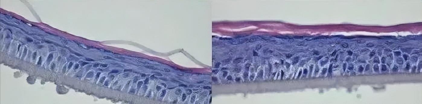 泰国美白针真实事件,女子连续打6年美白针