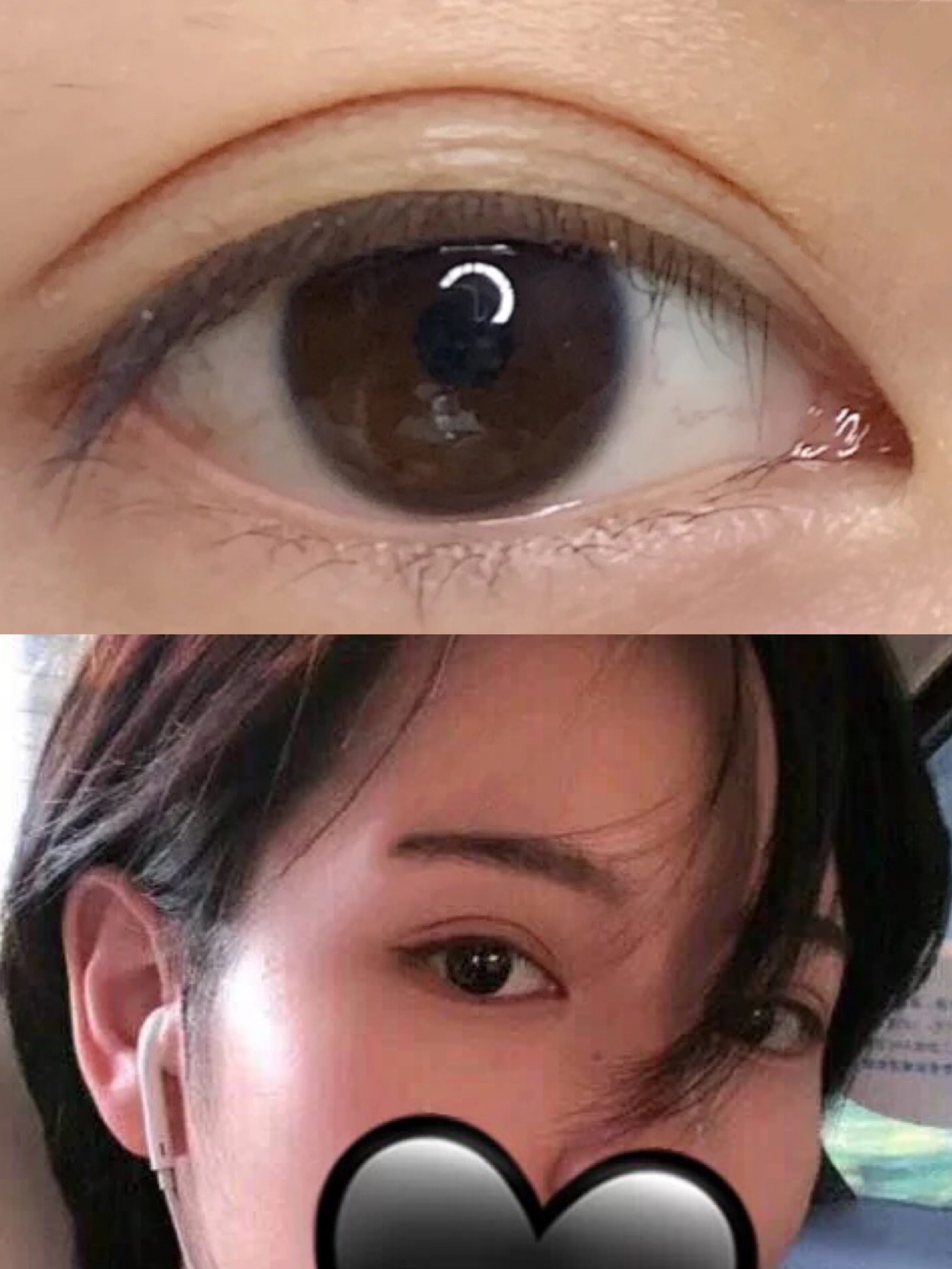 整形科普知识修复双眼皮,双眼皮整形有哪些常见方法