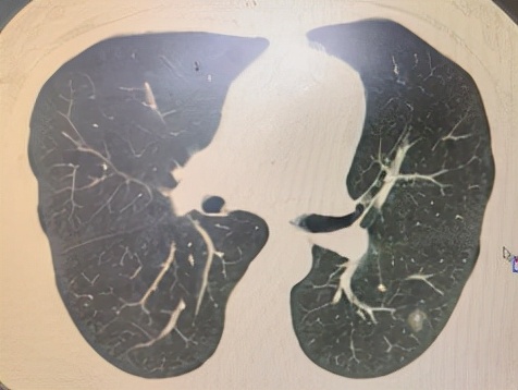 门医科普|肺癌全病程管理，科学防治肺癌系列问答