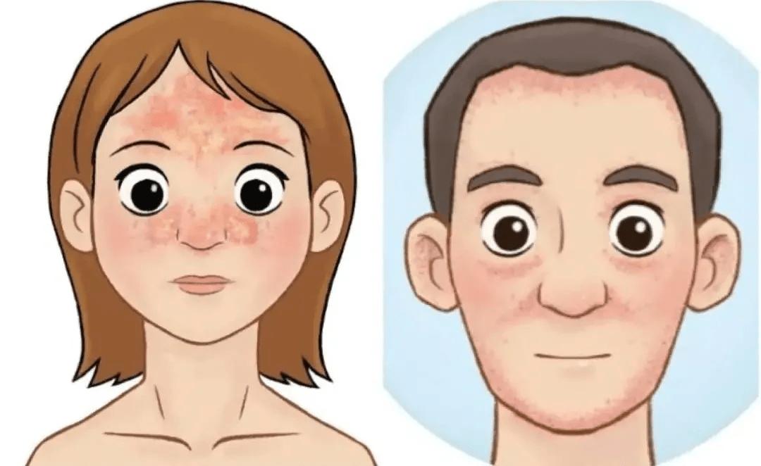 头皮上长红疙瘩脓包头皮屑特别多,头皮和脸上起疙瘩有脓包怎么回事