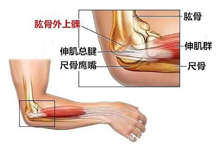 网球肘会引起胳膊肘伸不直吗,网球肘引起整个胳膊疼怎么办呢