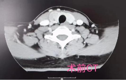 甲状腺囊实性结节微波消融好吗,甲状腺良性结节微波消融术优缺点