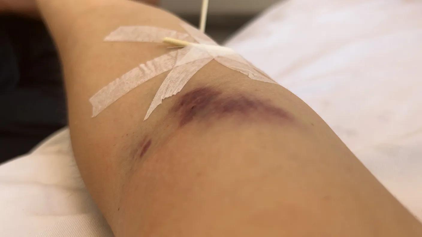 急性白血病的确诊依据,白血病m3的确诊方法