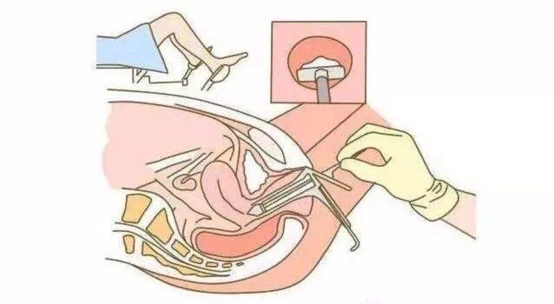 一项让女性“害怕”的妇科检查，它都查些什么？