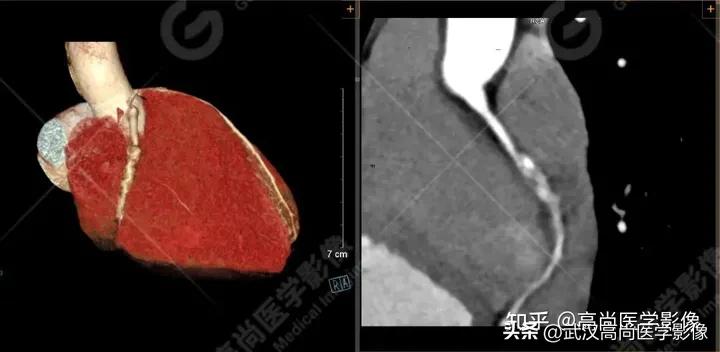 超声心动图可以用来诊断川崎病吗,心脏川崎病cta