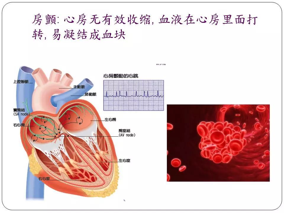 房颤预防最新消息,房颤警惕