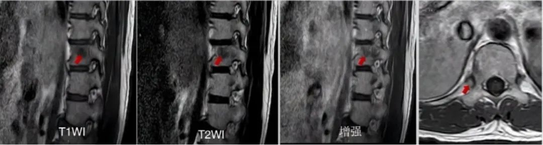 多原发癌症转移,多原发直肠癌
