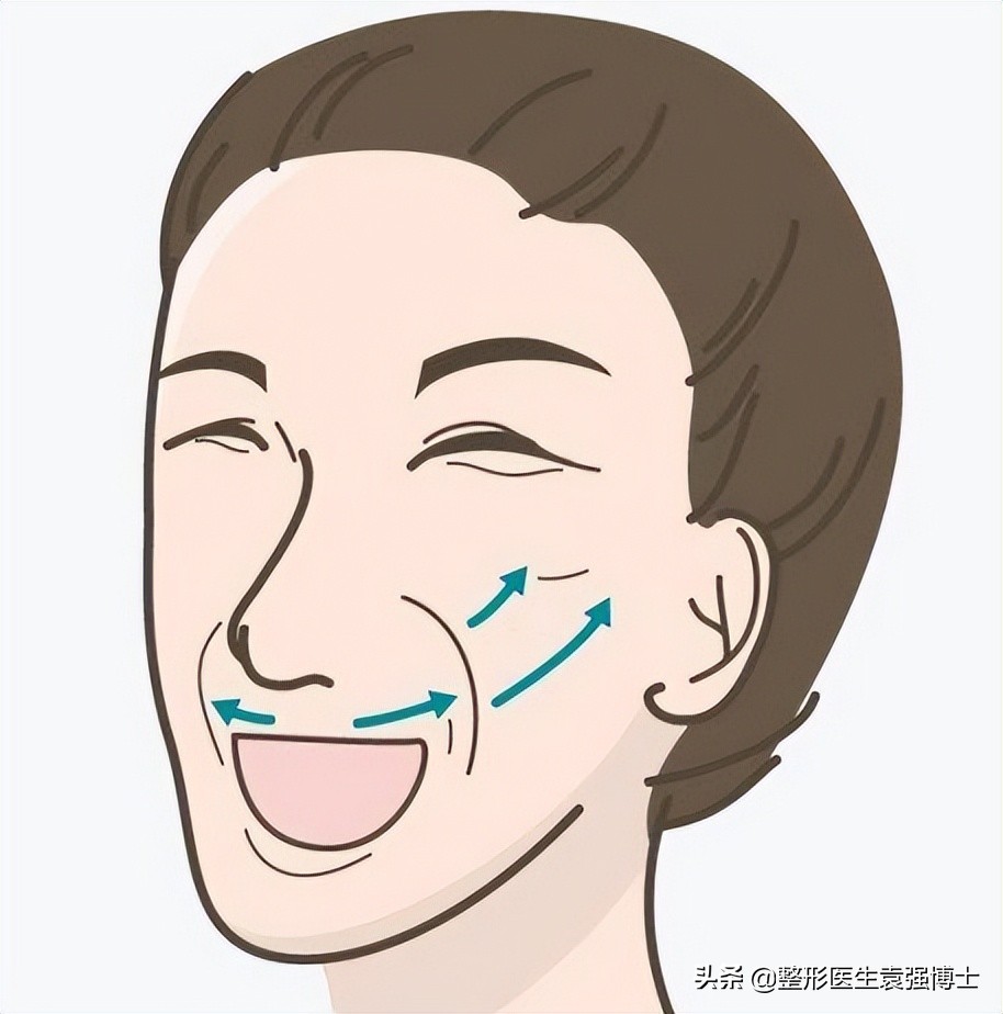 小拉皮是去除法令纹最好的方法,法令纹可以通过拉皮消除吗