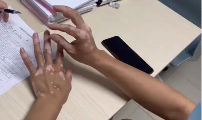 白癜风自愈的三大谣言,白癜风前期治疗是不是越来越明显