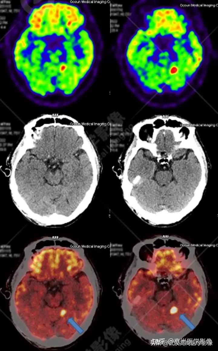 10毫米的肺结节恶性死亡率有多大,1厘米多的肺结节良性可能性多大