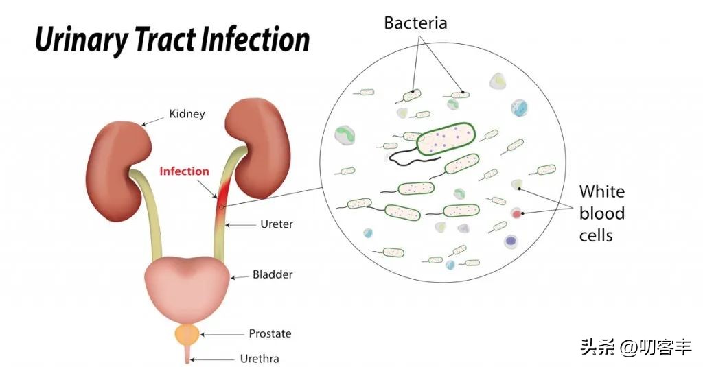 男孩子的尿路感染怎么治,男孩子反复尿路感染是怎么回事