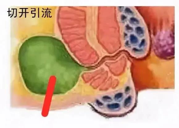 肛门疼有炎症吃什么药,肛门脓肿太疼吃什么药
