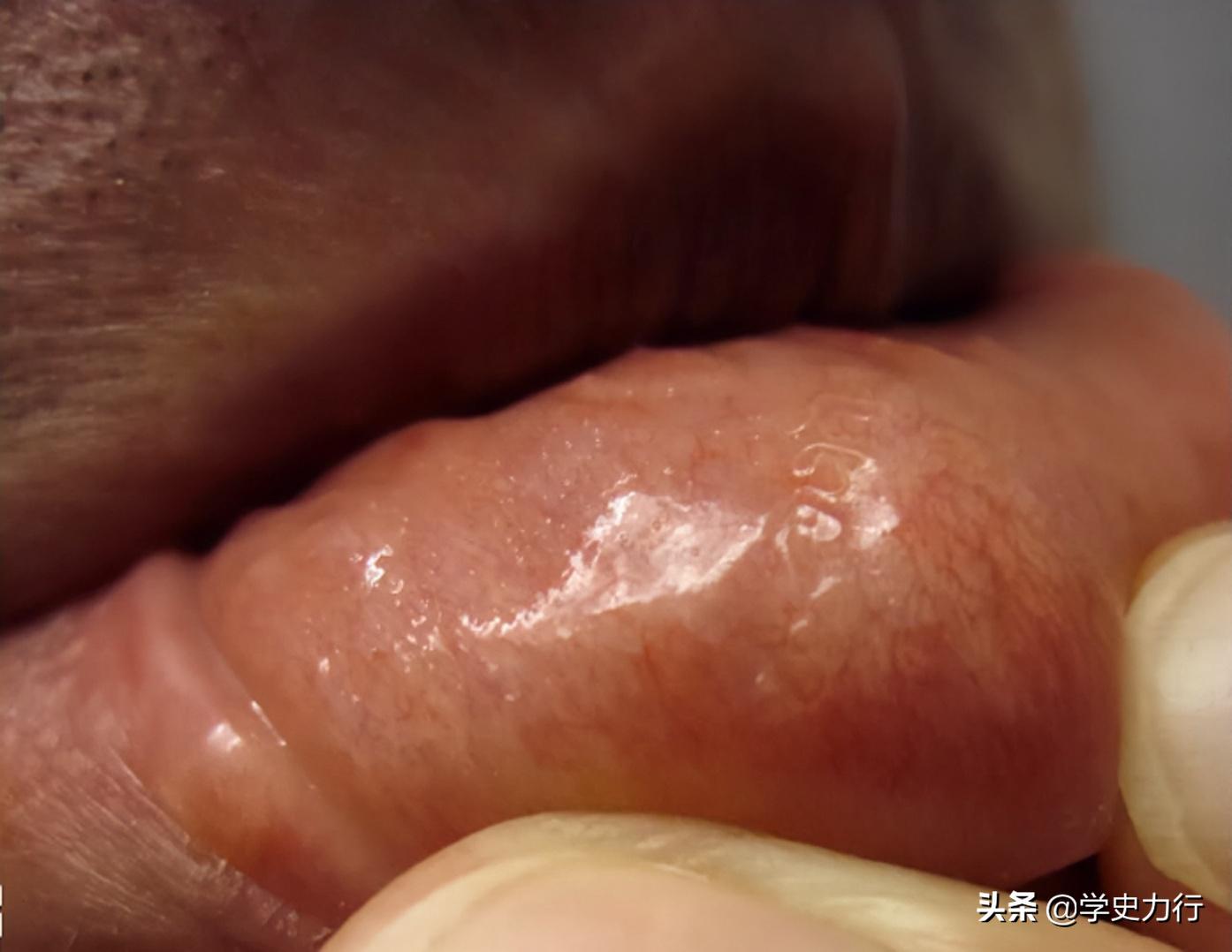 2011年，美国生物学教授感觉嘴里有异物，取出后发现是条罕见虫子