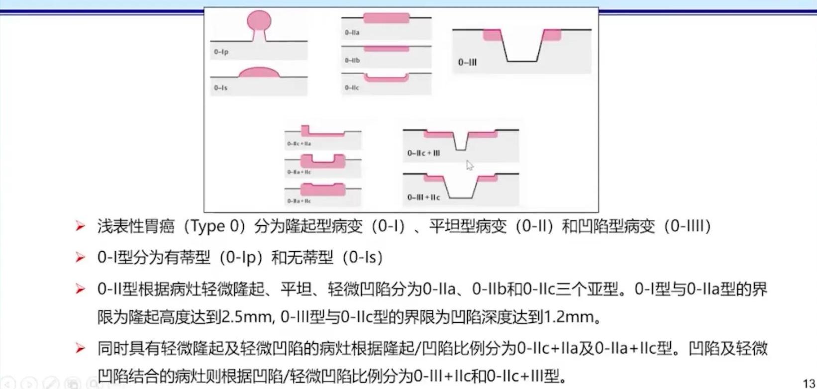 胃早癌食管早癌会复发吗,胃早癌与进展期癌怎么区分