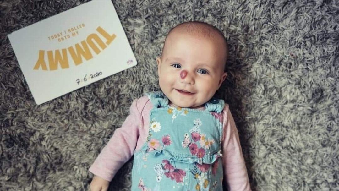 普萘洛尔可以用来治疗血管瘤吗,普萘洛尔治疗血管瘤的注意事项