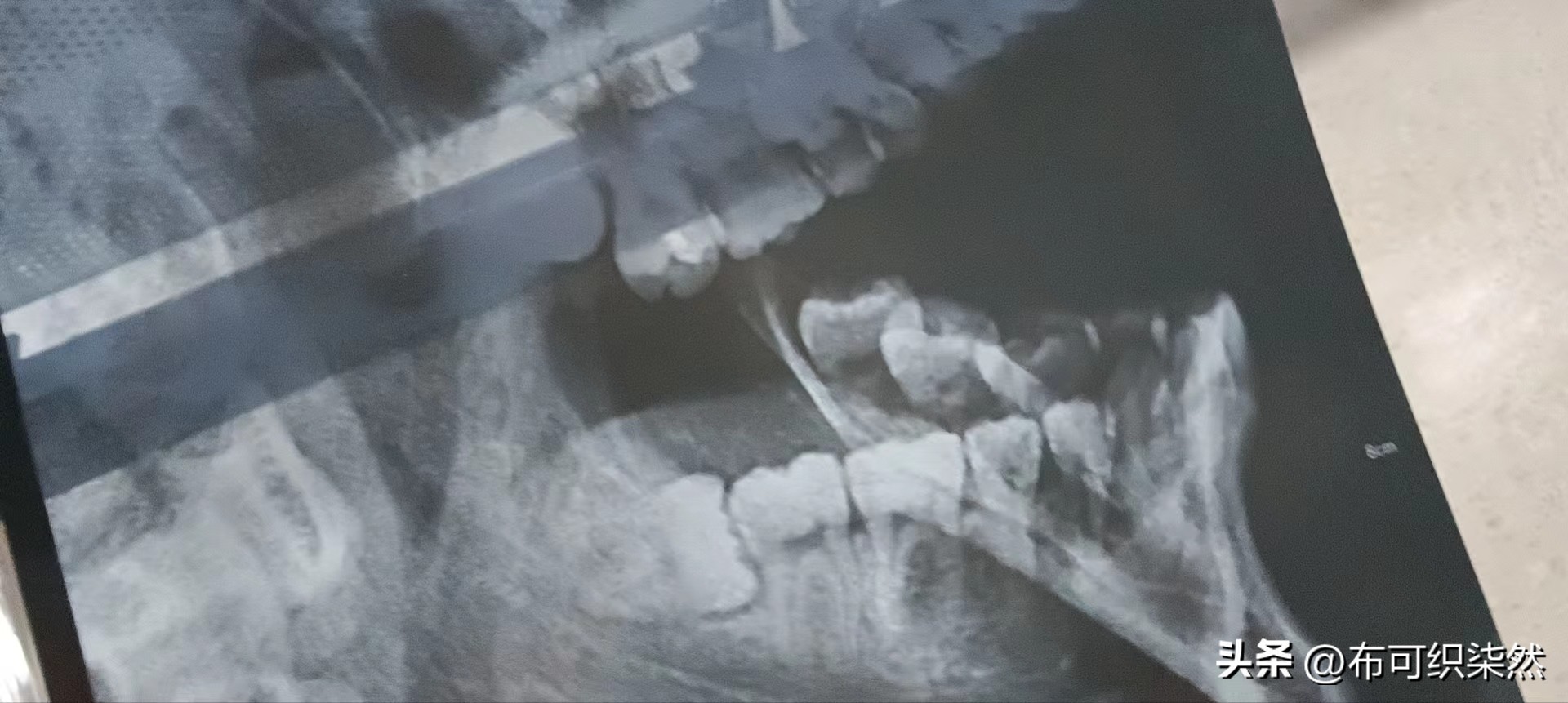 我与智齿的那些恩怨情仇,与智齿斗争的真实经历