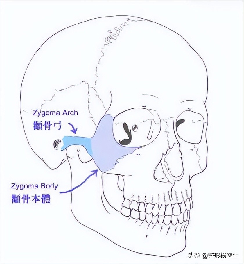 颧骨内推耳前凸起,鼻骨内推和颧骨内推可以一起做吗