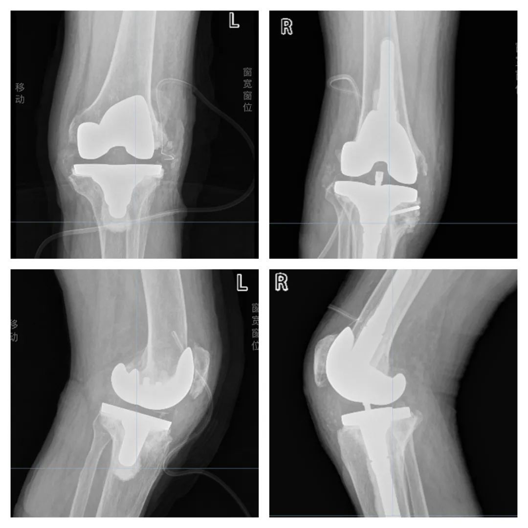 血友病患者的福音,禾正骨科助您完成轮椅上的“逆袭”!