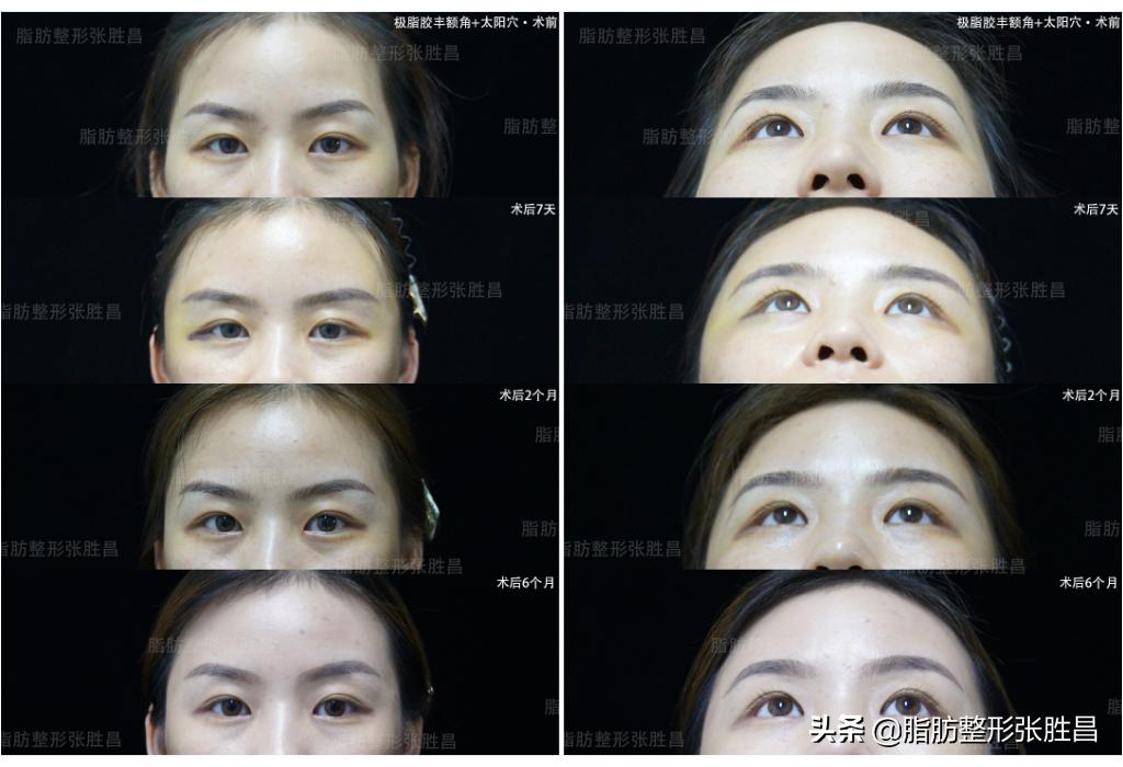 第一次做手术的人心里有点怕,第一次做脂肪填充效果