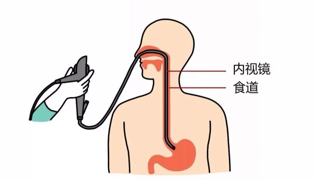 普通胃镜和无痛胃镜区别在哪里呢,无痛胃镜与普通胃镜的区别有哪些