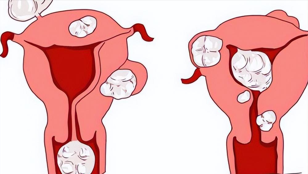 女子头晕胸闷,以为心肺不好,医生看到她的指甲怀疑子宫肌瘤