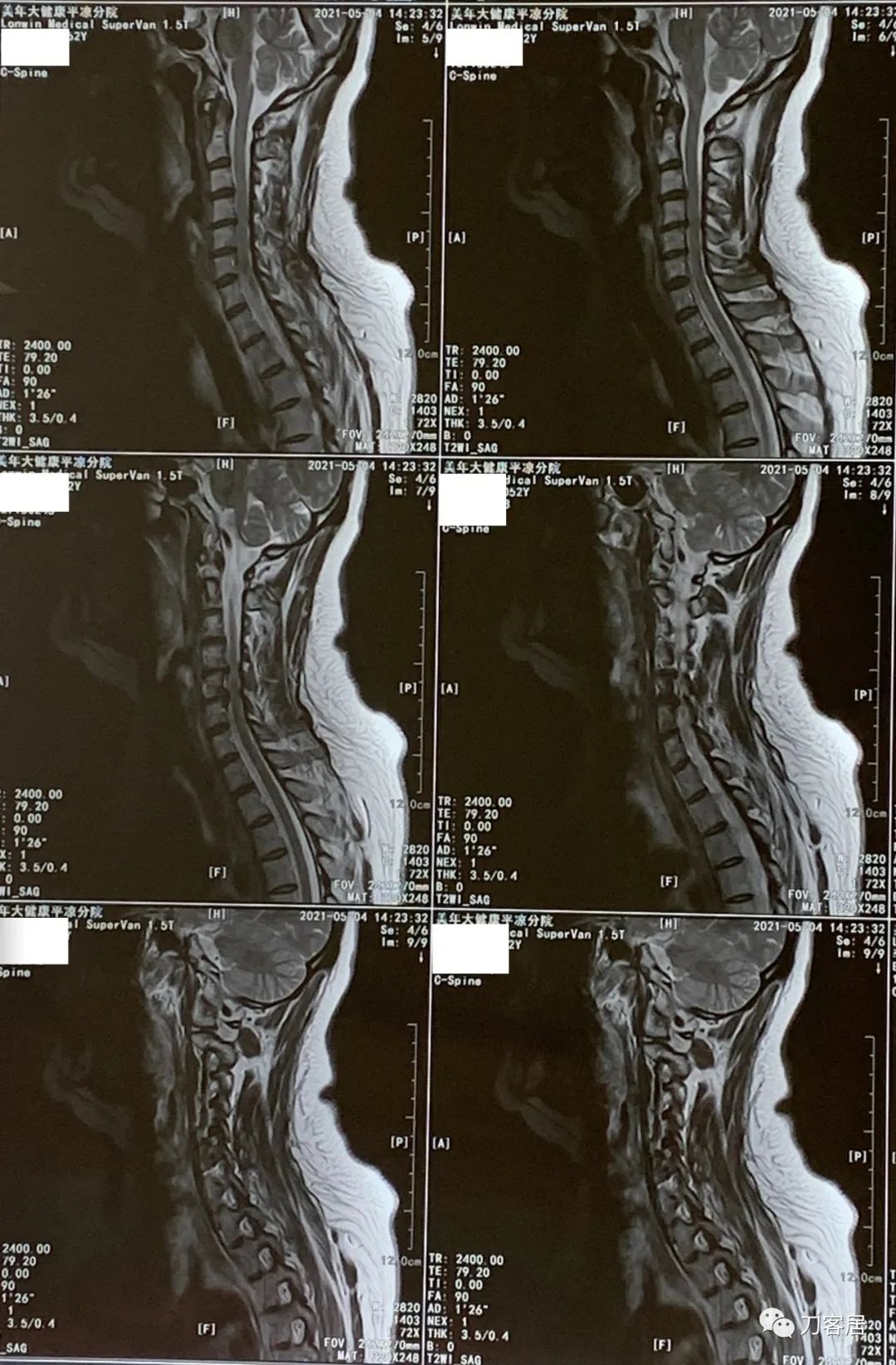 颈椎病十年了手臂酸痛肩背痛,颈椎病十年了一直痛怎么办