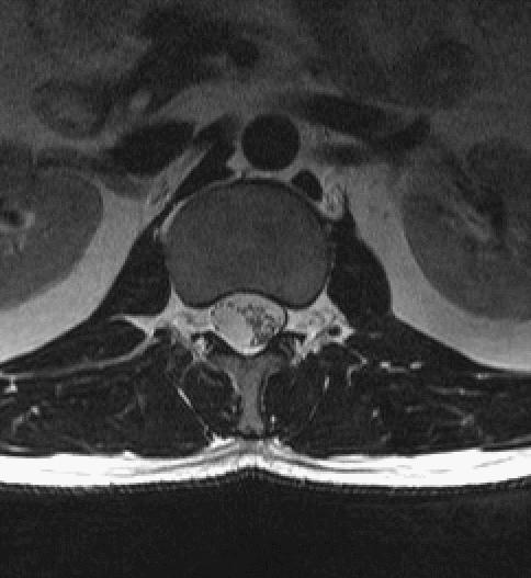脊柱多发血管瘤手术指征,椎管内良性肿瘤有哪些