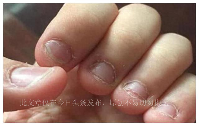 孩子总爱咬指甲吃点儿什么药,孩子总爱咬手指甲