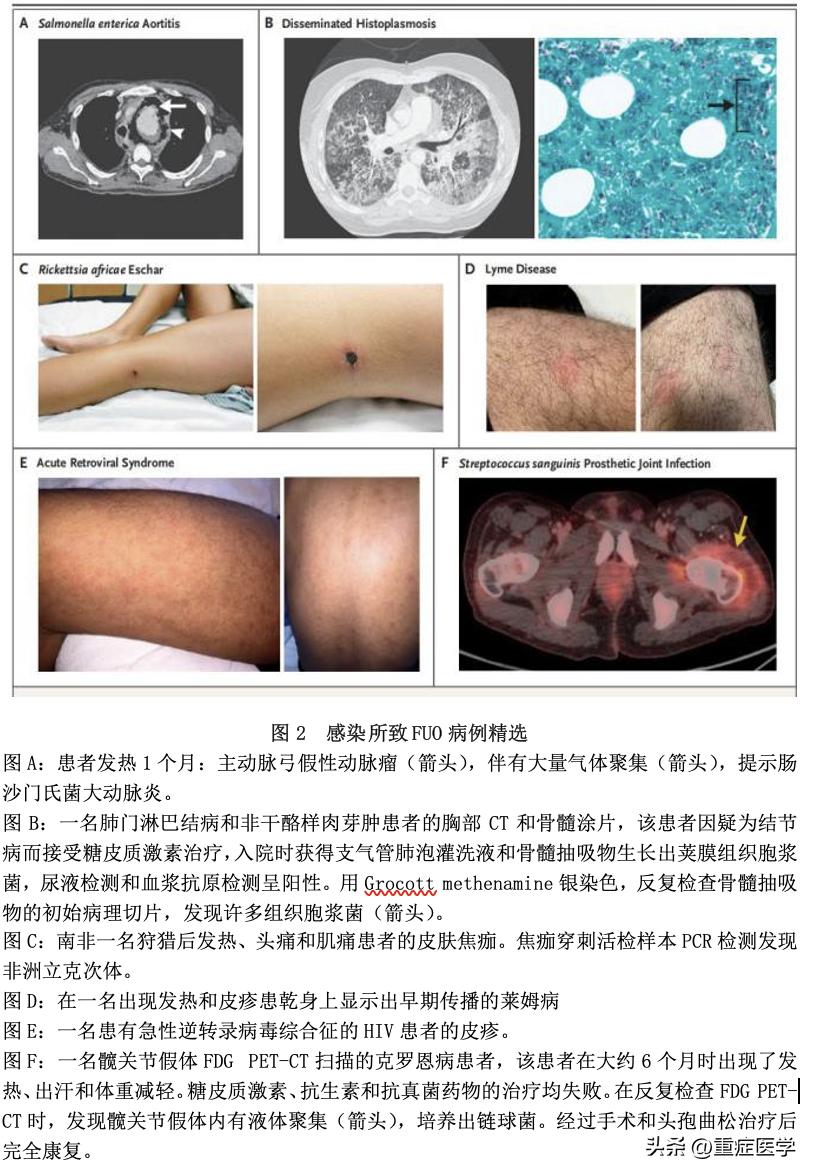 不明原因的发热药方,不明原因的发热