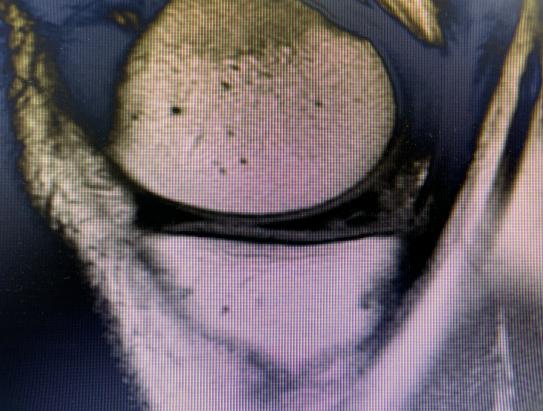 prp治疗膝关节退行性关节炎,骨性膝关节炎注射prp有效果吗