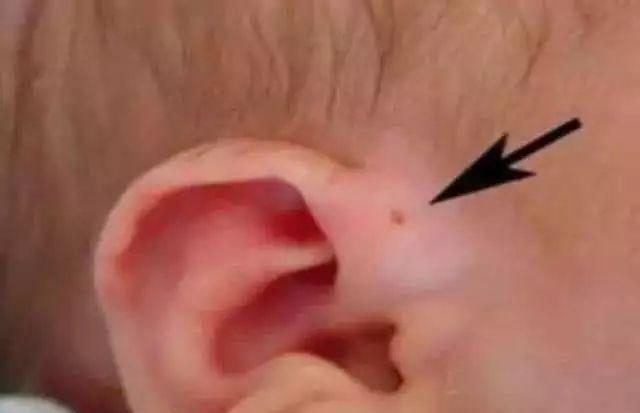 孩子耳朵有一个洞,小孩耳朵耳膜有一个小小的洞